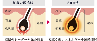 SHR脱毛のメリット